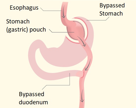 rouxeny gastric bypass