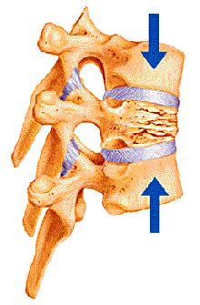 Vertebral Compression Fracture: Definition - Spine Info